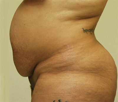 Tummy Tuck