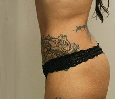 Tummy Tuck