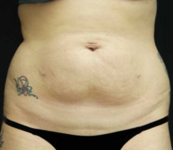 Tummy Tuck