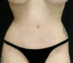 Tummy Tuck