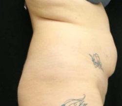 Tummy Tuck