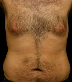 Gynecomastia