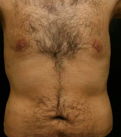 Gynecomastia