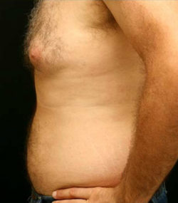 Gynecomastia