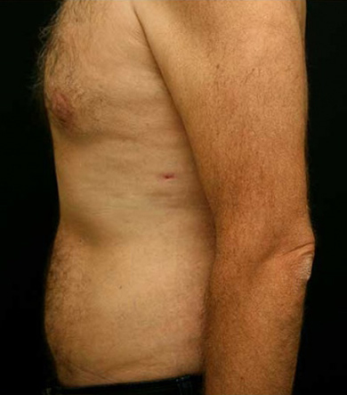 Gynecomastia