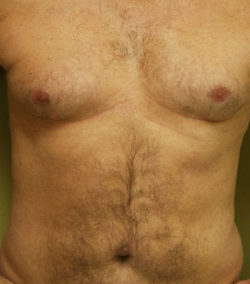 Gynecomastia