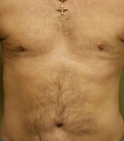 Gynecomastia