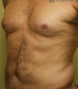 Gynecomastia