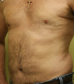 Gynecomastia