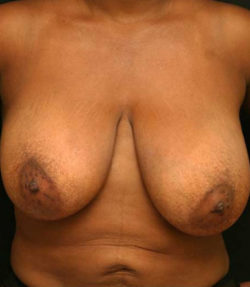 Breast Reduction
