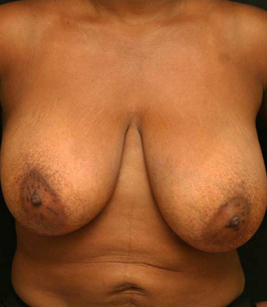 Breast Reduction