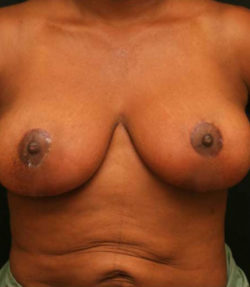 Breast Reduction