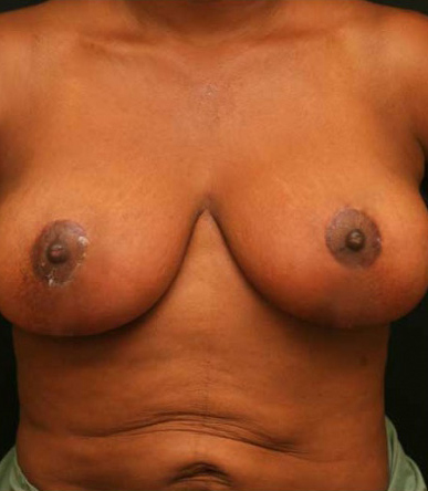 Breast Reduction