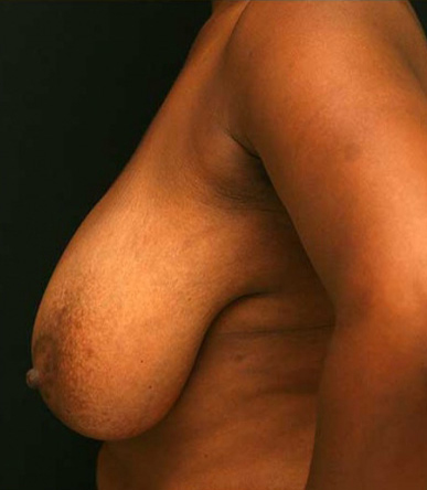Breast Reduction