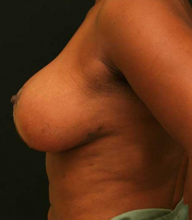 Breast Reduction