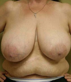 Breast Reduction
