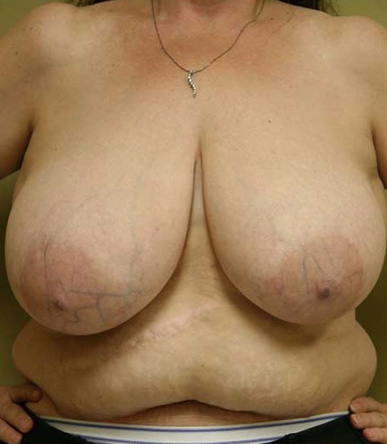 Breast Reduction
