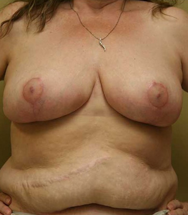 Breast Reduction