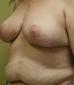 Breast Reduction
