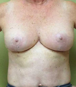 Breast Reduction