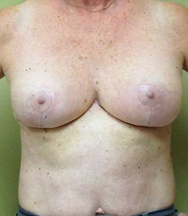 Breast Reduction