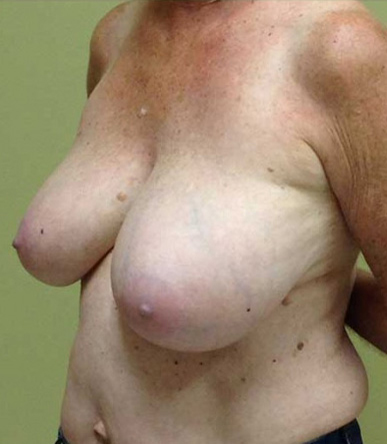 Breast Reduction