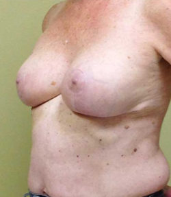 Breast Reduction