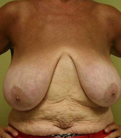 Breast Reduction