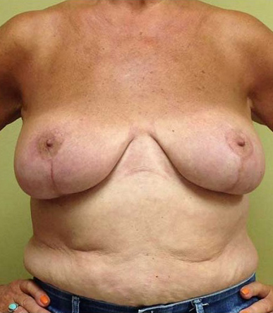 Breast Reduction