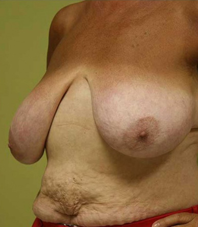 Breast Reduction