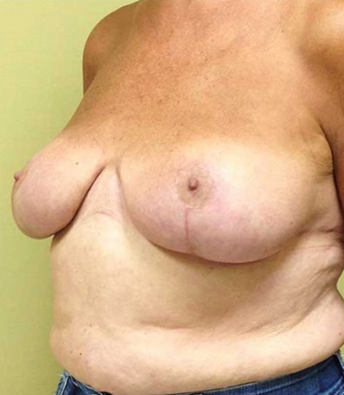 Breast Reduction