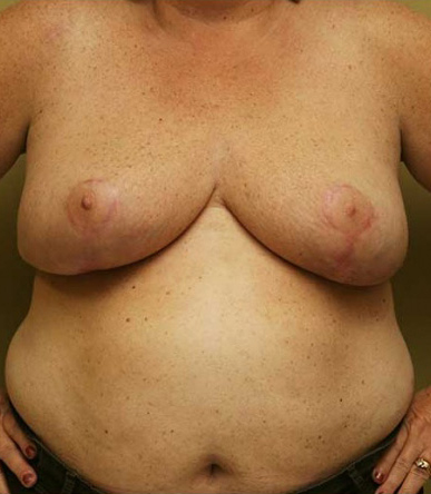 Breast Reduction