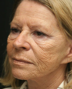 Facial Rejuvenation