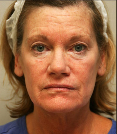 Facial Rejuvenation