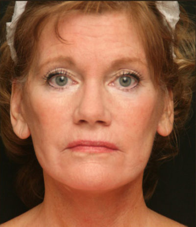 Facial Rejuvenation