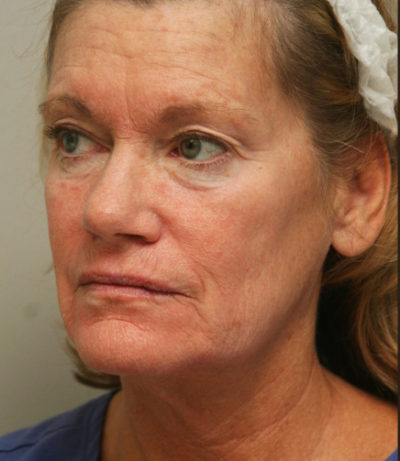 Facial Rejuvenation