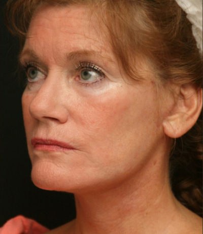 Facial Rejuvenation