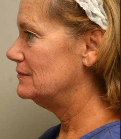 Facial Rejuvenation