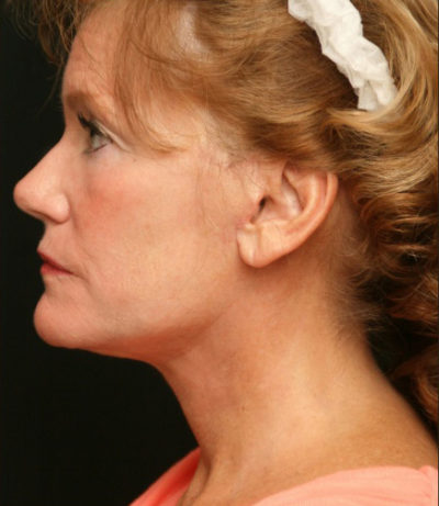 Facial Rejuvenation