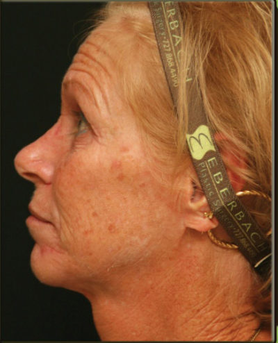 Croton Oil Peel