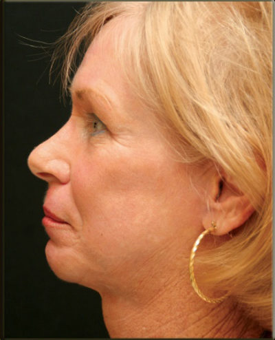 Croton Oil Peel