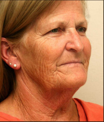 Facial Rejuvenation