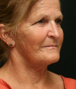 Facial Rejuvenation