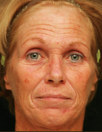 Croton Oil Peel