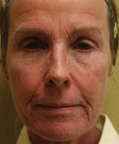 Croton Oil Peel