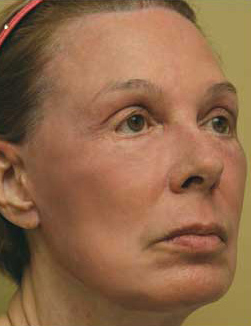 Croton Oil Peel