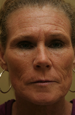 Croton Oil Peel