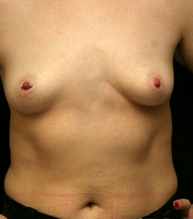 Breast Augmentation