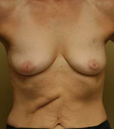 Breast Augmentation