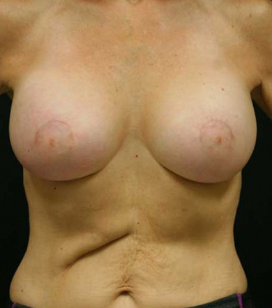 Breast Augmentation